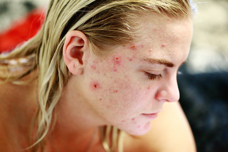 cicatrice acne